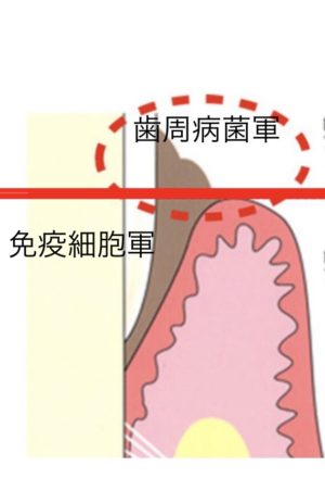 歯周病