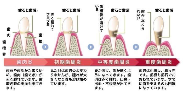 歯周病とは