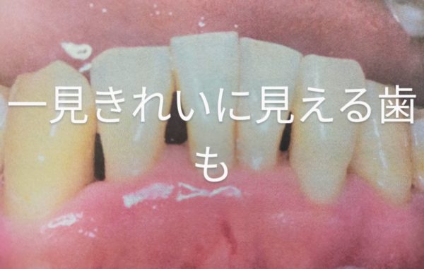 染めだし　歯周病