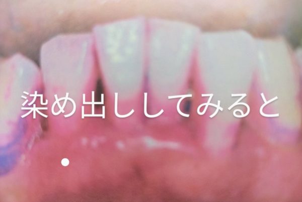 染めだし　歯周病