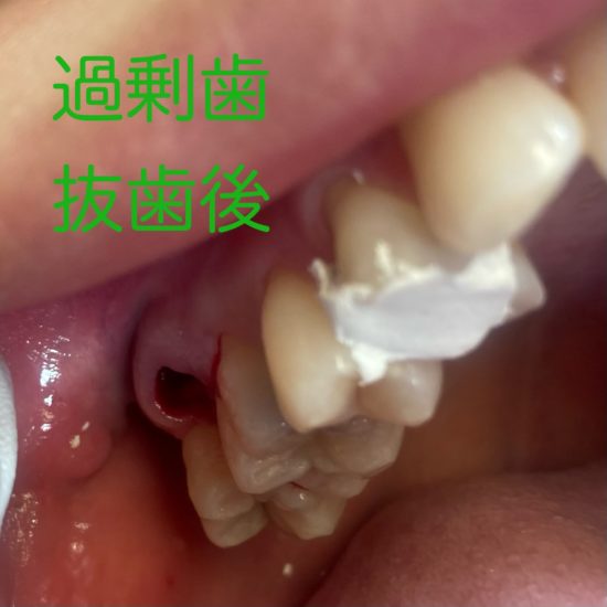 過剰歯 抜歯