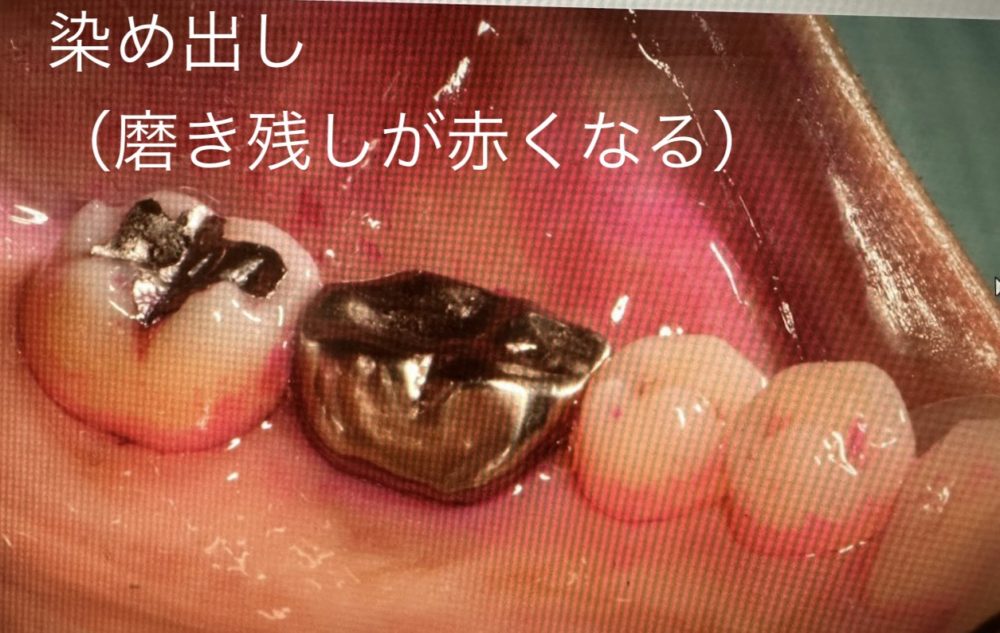 プラークの染め出し・スケーリング
