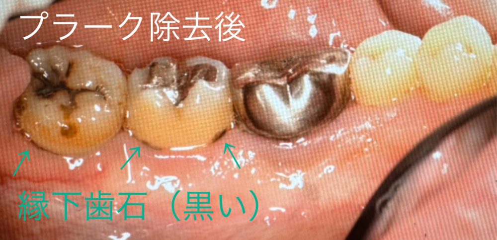 スケーリング・縁下歯石