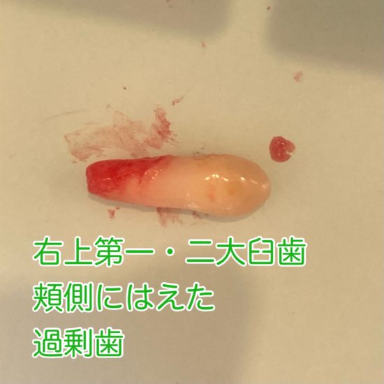 過剰歯 抜歯